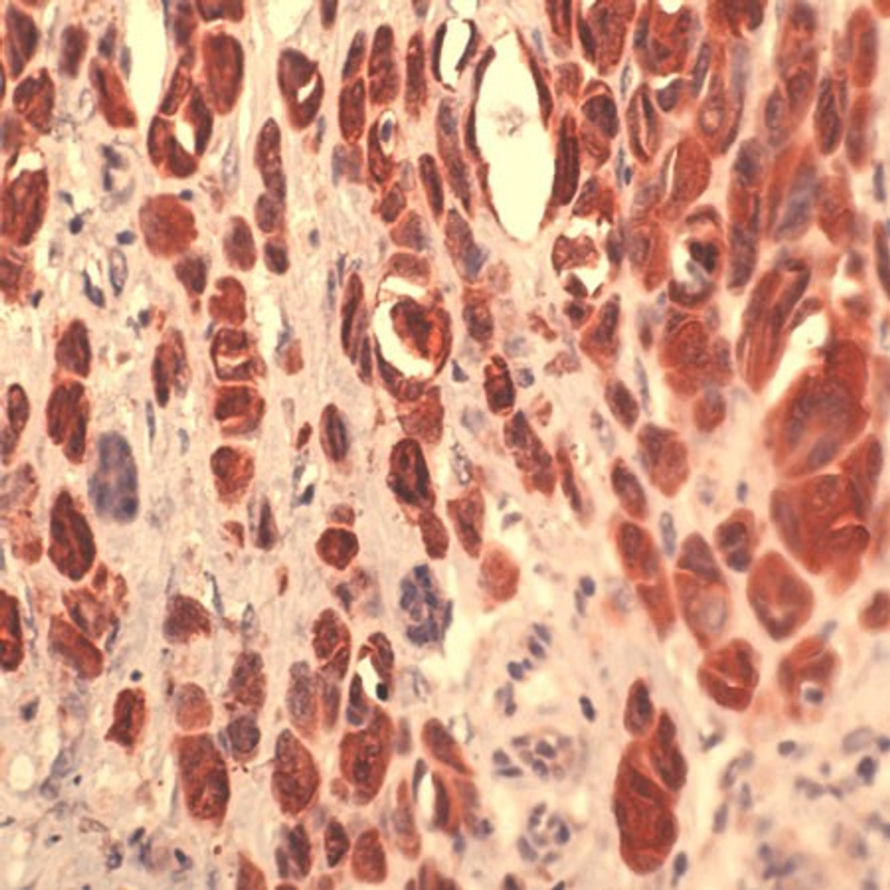 Immunohistochemistry staining of S100A4 in melanoma tissue using S100A4 Antibody.