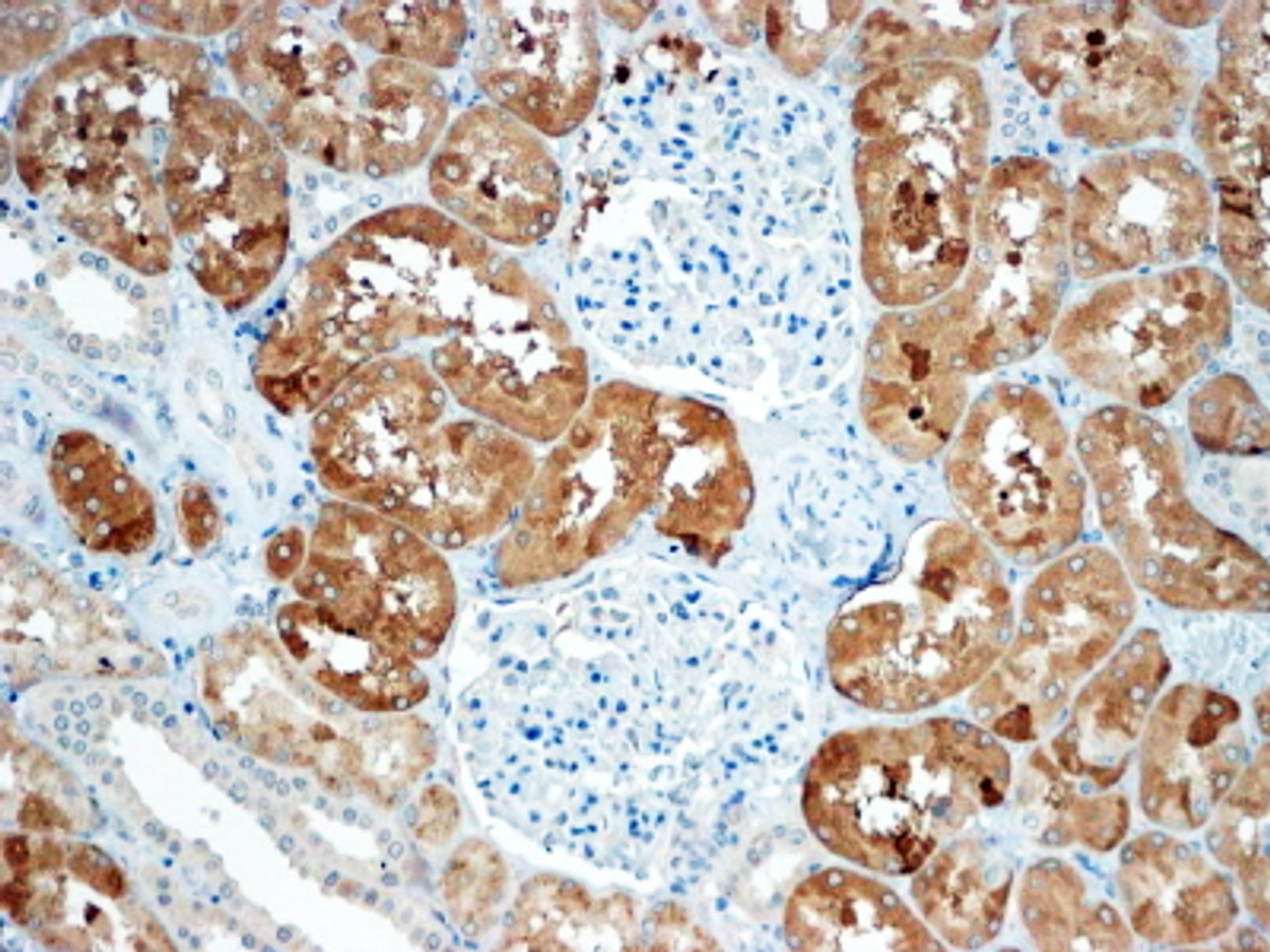 43-578 (0.3ug/ml) staining of Human Colorectal cancer lysate (35ug protein in RIPA buffer) . Primary incubation was 1 hour. Detected by chemiluminescence.