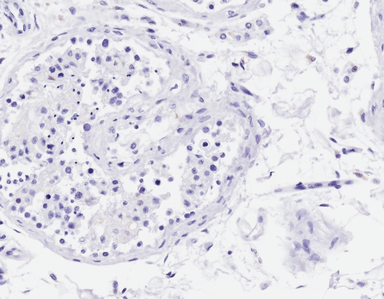 43-633 (1ug/ml) staining of Jurkat (A) and Molt4 (B) lysates (35ug protein in RIPA buffer) . Primary incubation was 1 hour. Detected by chemiluminescence.