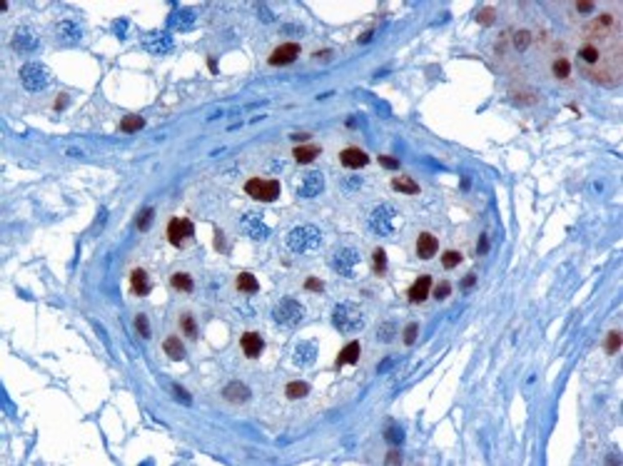 45-814 (3ug/ml) staining of paraffin embedded Human Testis. Microwaved antigen retrieval with citrate buffer pH 6, HRP-staining. <strong>This data is from a previous batch, not on sale.</strong>