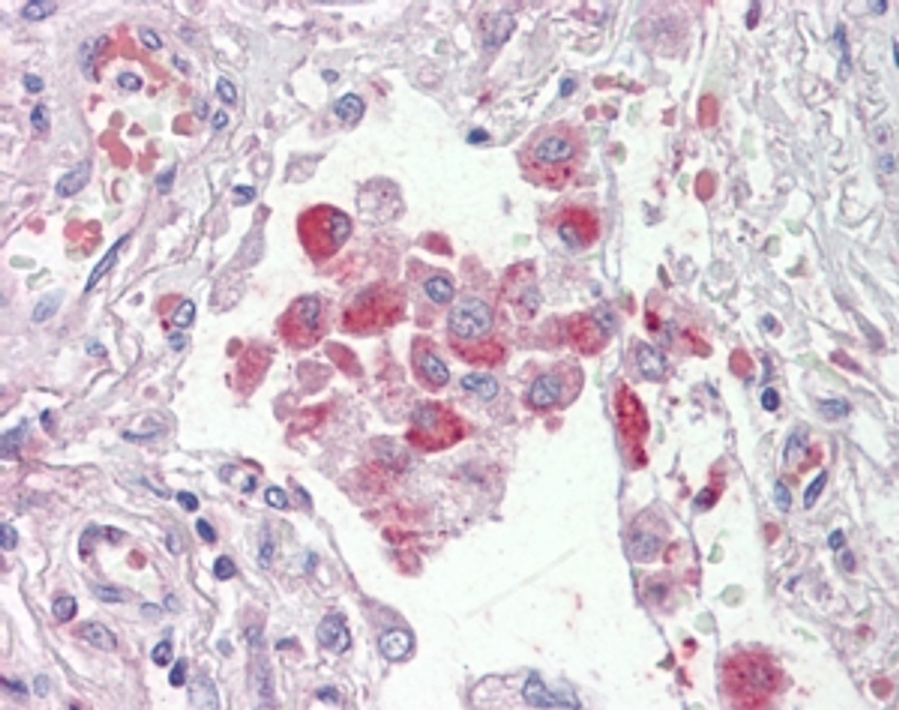 46-112 (2.5ug/ml) staining of paraffin embedded Human Lung. Steamed antigen retrieval with citrate buffer pH 6, AP-staining.