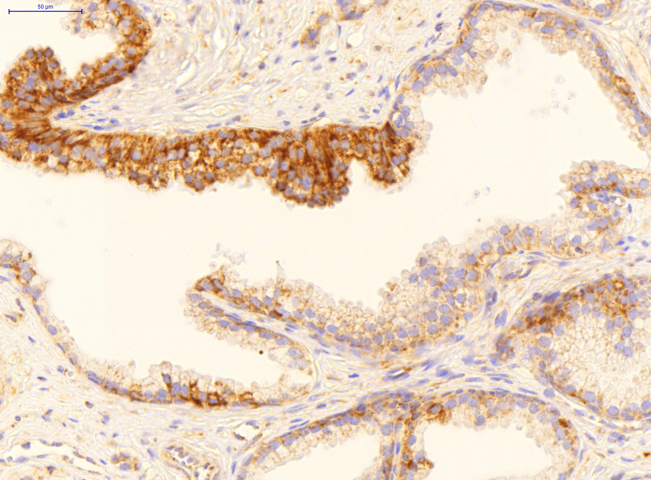 Antibody used in IHC on Human Prostate Cancer at 2 ug/ml.