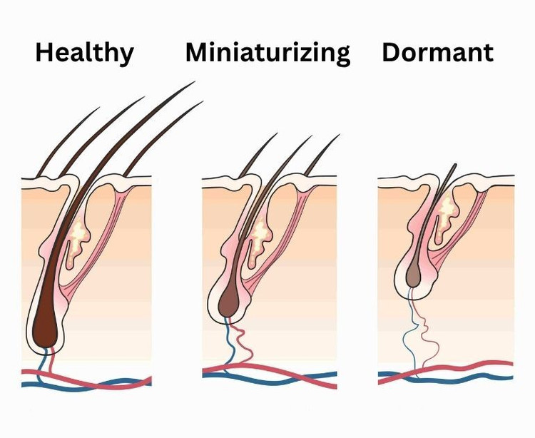 Illustration of three hair follicles in the scalp, labeled Healthy, Miniaturizing and Dormant: the hair gets thinner and shorter, and the follicle smaller, from left to right.