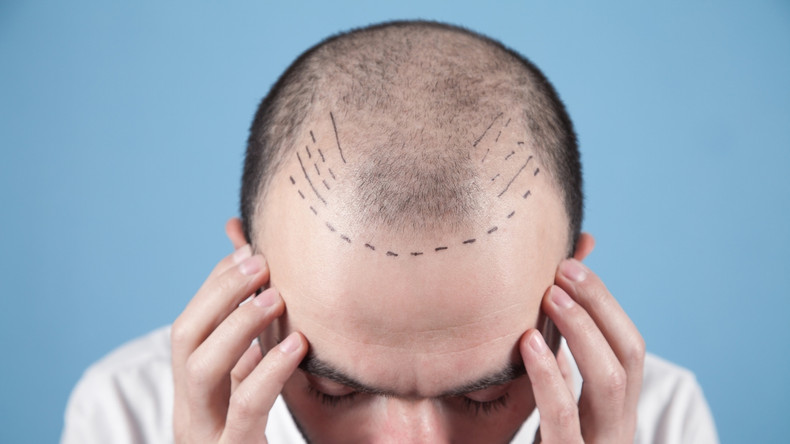 The Shocking Truth: Why Your Hair Started Falling Out at 25 (And What to Do About It)