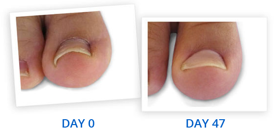 Ingrowing Toe Nails — The Podiatry Clinics