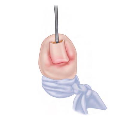 Ingrown Toenail Treatment - Skin Surgery Clinic