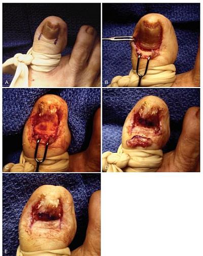 Ingrown Toenail Surgery