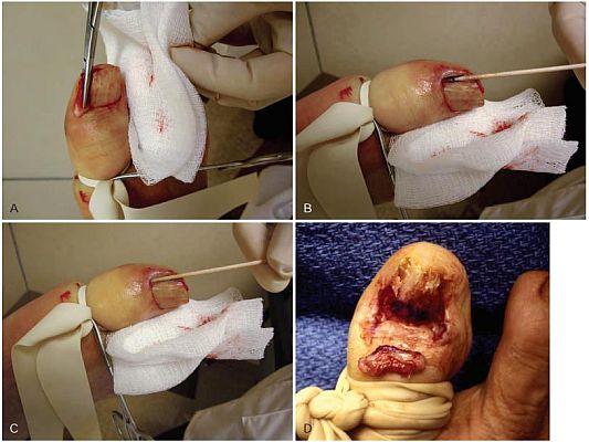 About Ingrown Toenail Surgery