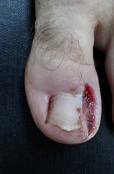 Ingrown Toenail Surgery