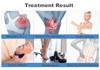 physiotherapy diathermy tecar therapy face lift monopolar rf body slimming machine