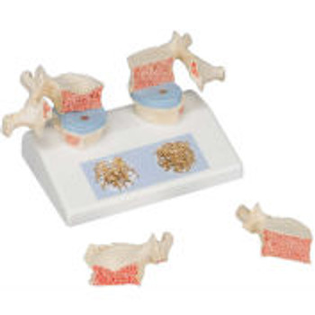 3B® Anatomical Model - Osteoporosis Model