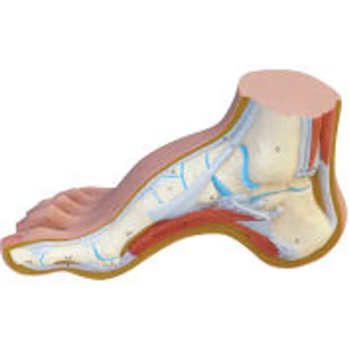 3B® Anatomical Model - Hollow Foot (Pes Cavus)