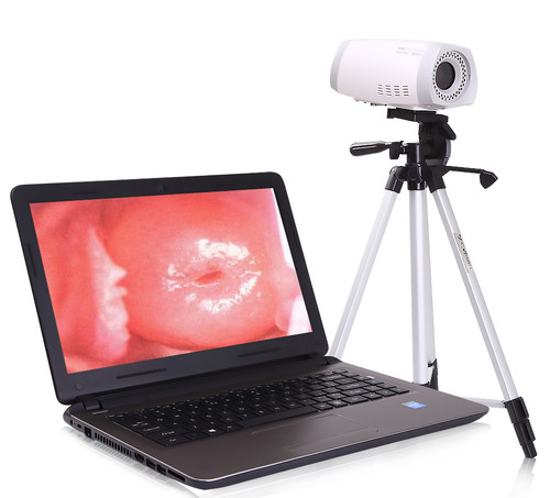 PL-9800 Video Portable Colposcope