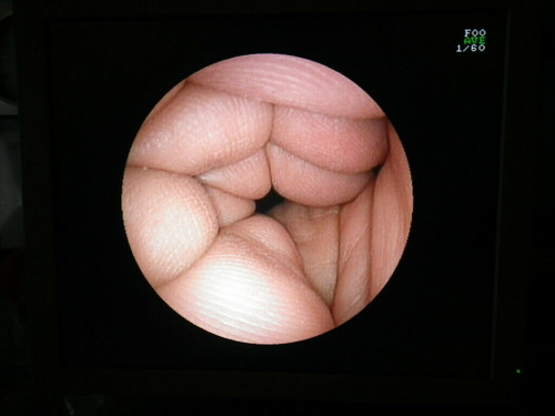 Fujinon Endoscope Slim Gastroscope Eg-530N2 With Case & Valve