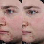 Clarifying Mandelic Peel 60ml