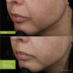 Ultra LumiBright Brightening Peel