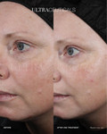 Ultra LumiBright Brightening Peel