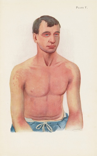 Digital Print - Plate V. Erythema of skin from general exposure to the vapour of Yellow Cross substance by A. Kirkpatrick Maxwell