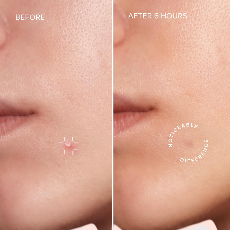 MARÉE - MARINE COLLAGEN PIMPLE PACTCHES
