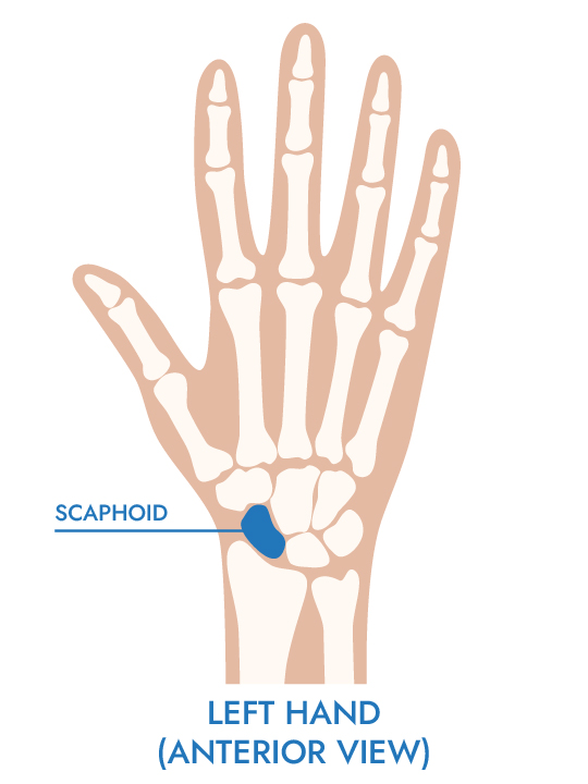 Diagram of the bones in the hand, pointing out the scaphoid bone.