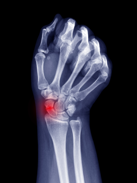 X-Ray scan of the right hand (posterior) showing a fractured scaphoid bone, highlighted with a red glow.