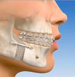 Recovery From Jaw Surgery