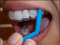 Retainer and Invisalign Removal Tools