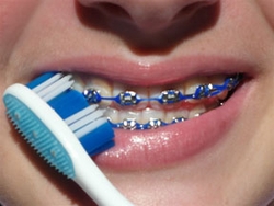 How to Brush and Floss Your Braces