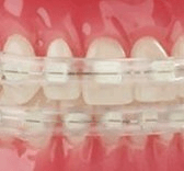 Dental Wax Alternatives and Lip Protectors