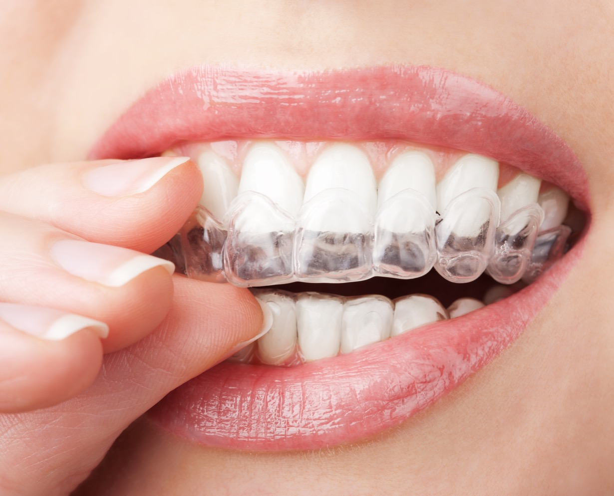 Quick And Easy Hacks To Remove Invisalign Trays And Invisible Braces