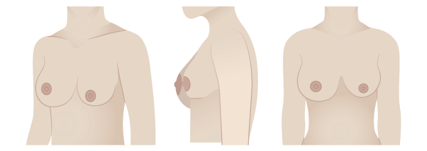 Breast Shape Guide