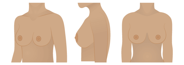 Breast Shape Guide