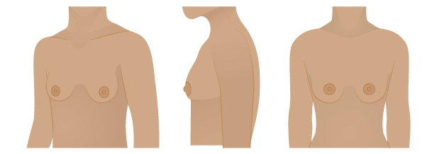 Which Breast Shape Am I?