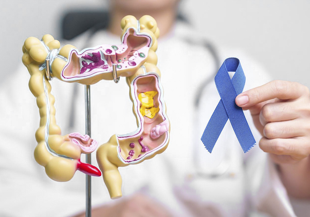 Detección de cáncer de colon en Farmacia Montserrat Tallada en Lloret de mar, Girona