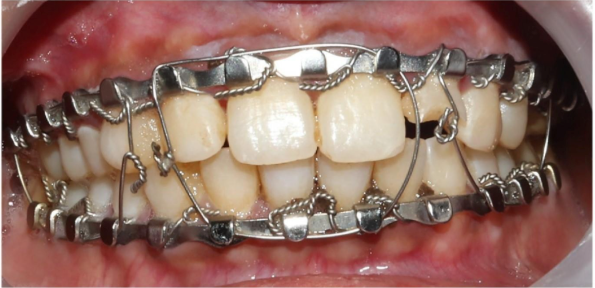 Why Trauma Centers are Shifting to Sterile, Pre-Cut Dental Wires and Arch Bars 