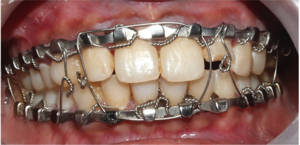 Why Trauma Centers are Shifting to Sterile, Pre-Cut Dental Wires and Arch Bars 
