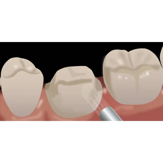 indirect restoration dispensing porcelain etchant step 7