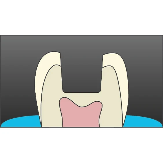 posterior composite quantium technique 1