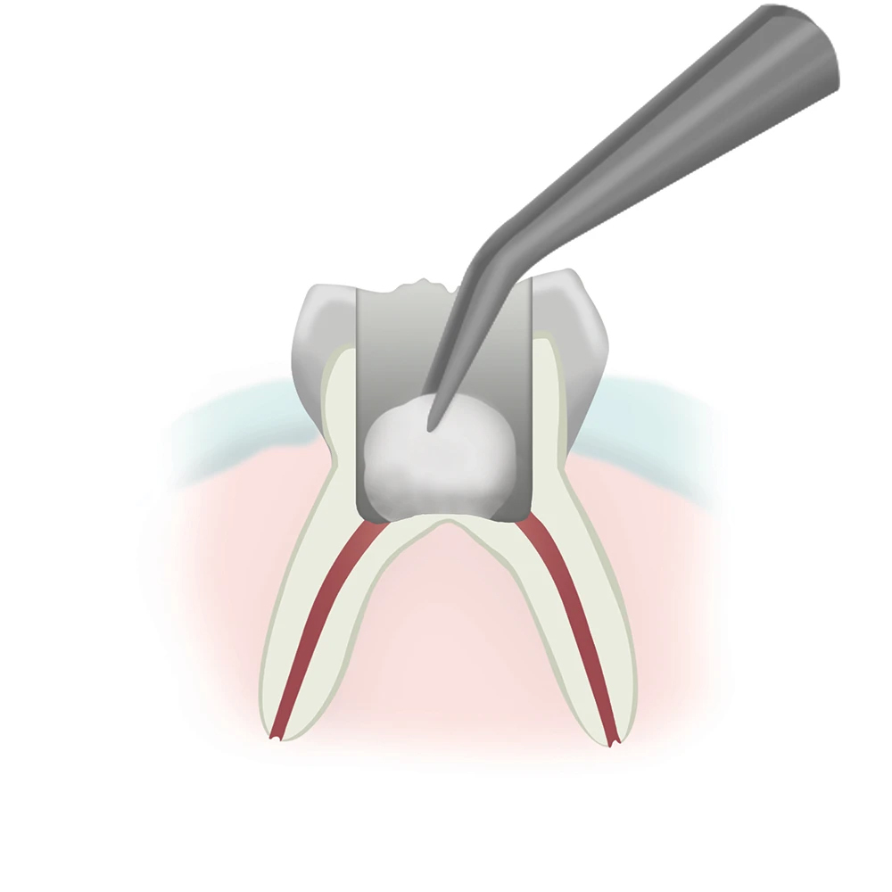 Pulpotomy Step 2