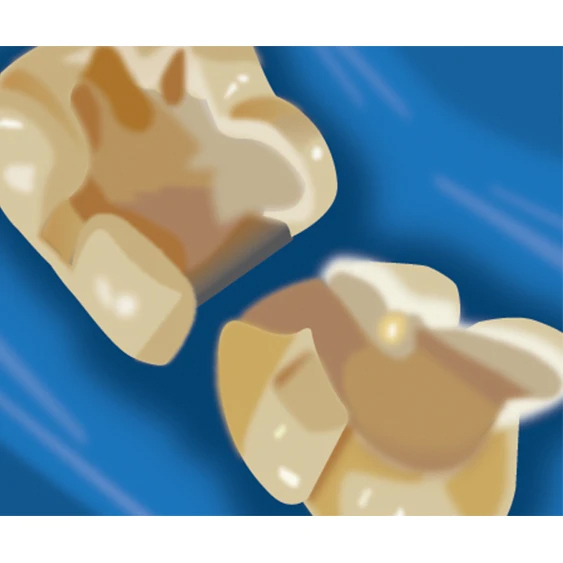 Indirect Pulp Capping - TheraCal LC Step 1