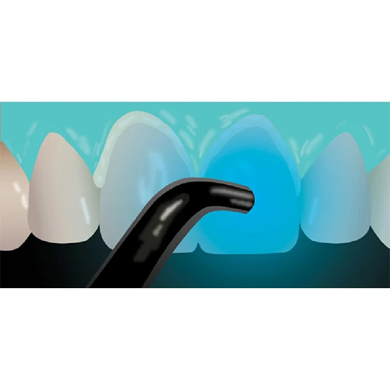 Veneer Cementation of Glass Ceramics Step 10