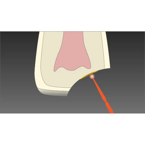 anterior composite restorations step 2