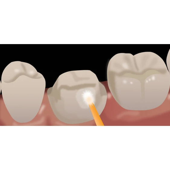 indirect restoration dispensing porcelain etchant step 6