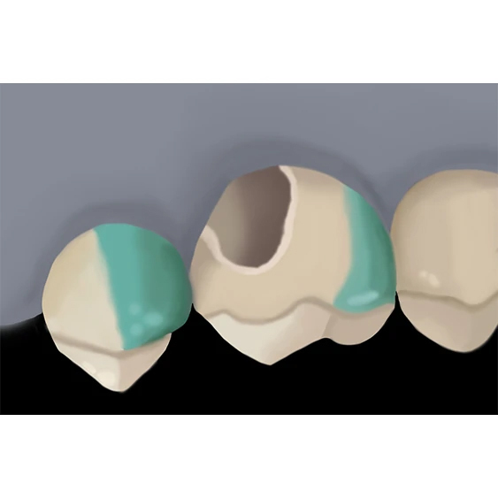 Intraoral Repair with z prime step 1