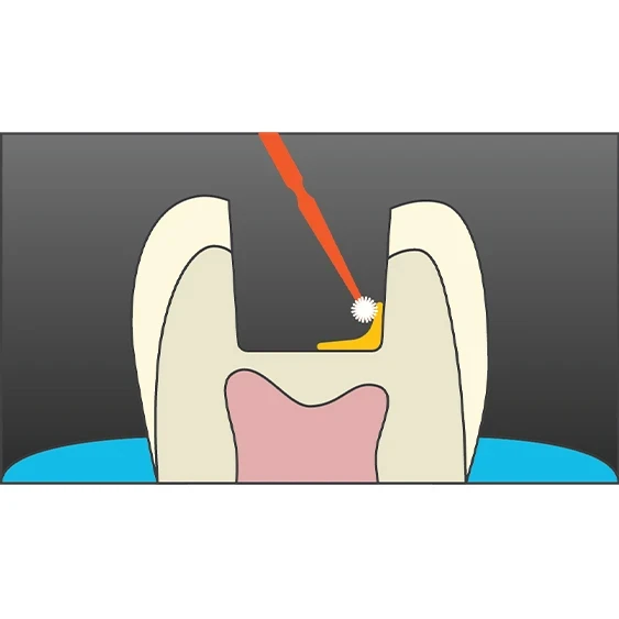 posterior composite quantium technique 2