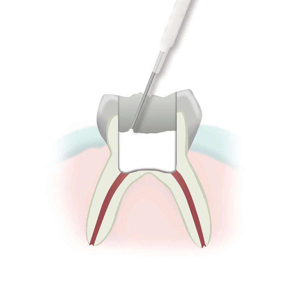 Pulpotomy Step 3