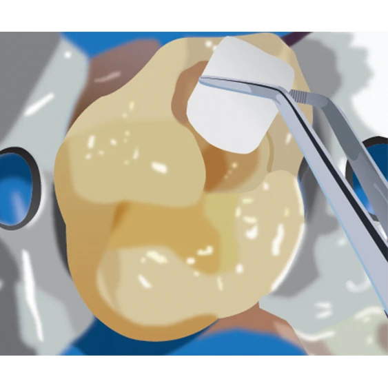 Direct Pulp Capping - TheraCal LC step 2