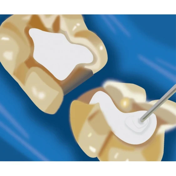 Indirect Pulp Capping - TheraCal LC Step 2