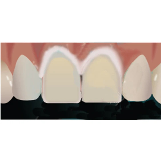 Veneer Cementation of Glass Ceramics Step 3