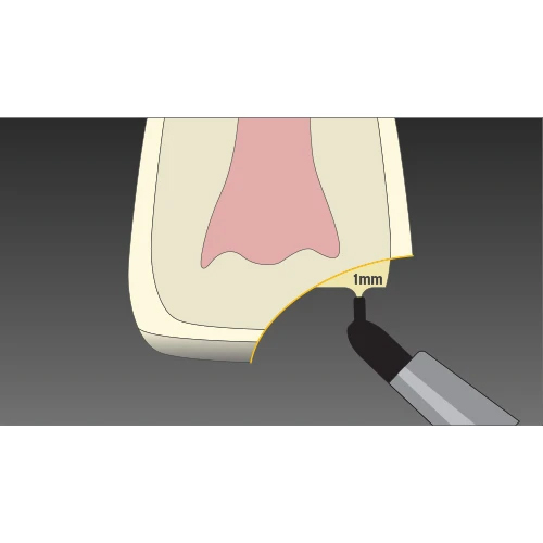 anterior composite restorations step 3